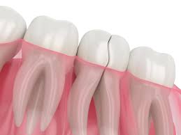 My Wisdom Tooth Dentist
