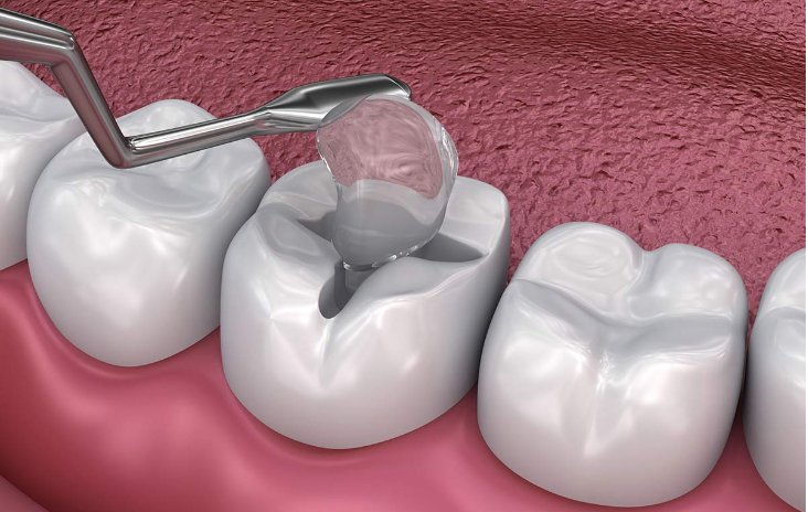 Dental Fillings