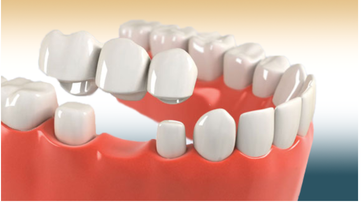 DENTAL CROWNS AND BRIDGES