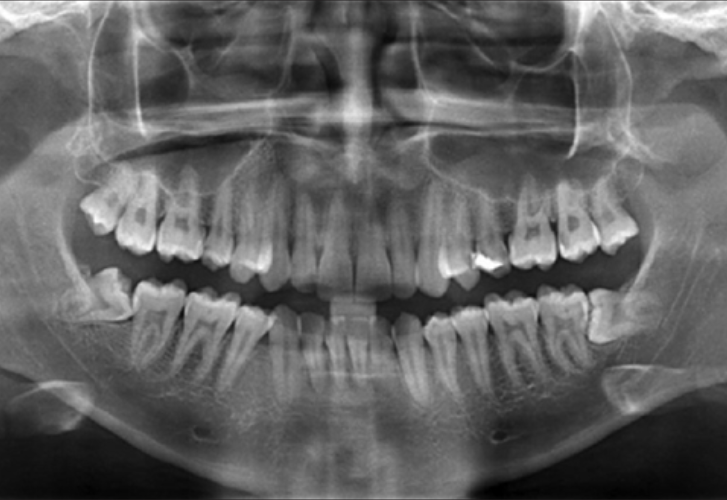 X-ray