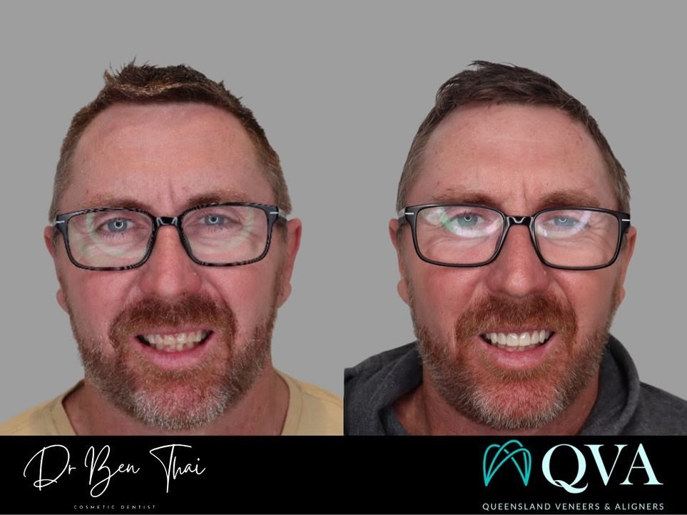 Queensland Veneers & Aligners
