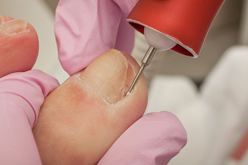 The image depicts a close-up view of a podiatrist working on a toenail. A professional, wearing disposable gloves, is using a precision instrument to treat the toenail, which appears to have a thickened or discoloured surface. This procedure is commonly associated with podiatric care, aiming to improve foot health and address issues such as ingrown toenails or fungal infections. The setting is clean and clinical, indicative of a health care environment, focusing on patient care and foot treatment.